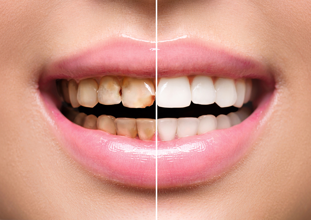 How to Restore Your Smile From Tooth Wear with Restoration